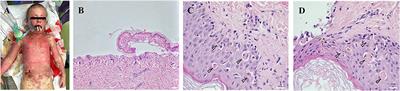 Case Report: Wound Closure Acceleration in a Patient With Toxic Epidermal Necrolysis Using a Lyophilised Amniotic Membrane